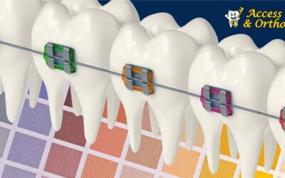 Braces Colors: How to Choose the Best Color for Your Smile