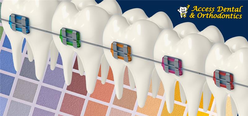 Braces Colors: How to Choose the Best Color for Your Smile