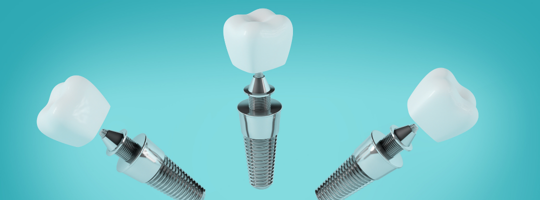 How Do Dental Implants Work?