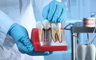 Are dental implants right for me?