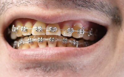 Tooth Decay with Braces