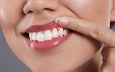 How Long Does It Take for Gums to Heal After A Tooth Extraction?