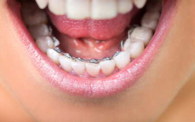 Lingual Braces: A Comprehensive Guide