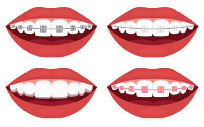 Which Type of Braces Are Best?