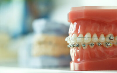 Most Common Problems Braces Can Fix