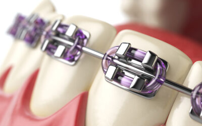 What Are the Pros & Cons of Metal Braces?